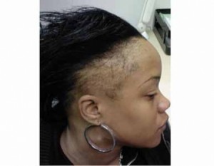 alopecia thyblackman thinning