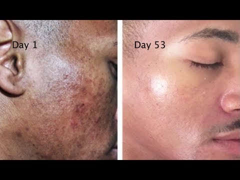 Turmeric mask for hyperpigmentation before and after