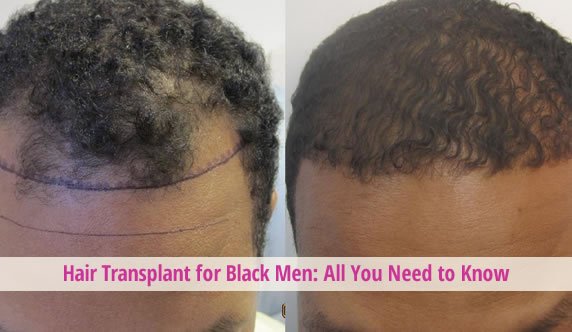 black men hair transplant