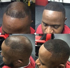 The Best Treatments For Male Pattern Baldness. : ThyBlackMan