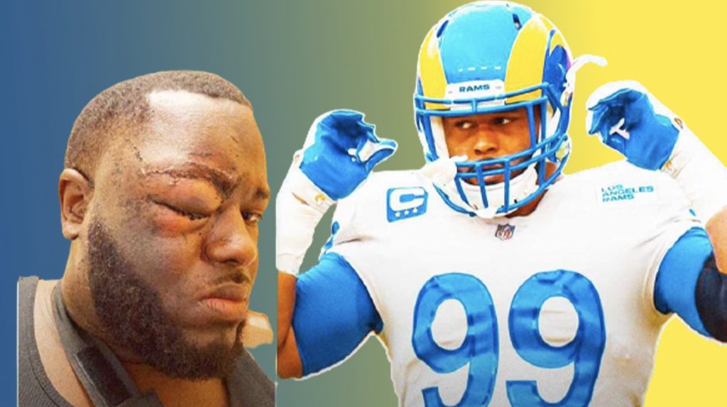 Aaron-Donald-Fight-BLACKEYE